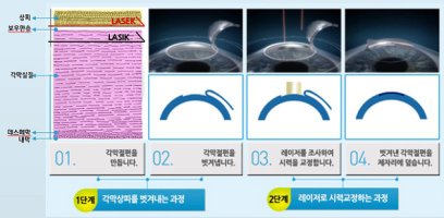 서면라식2
