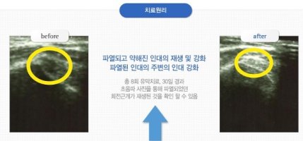 어깨인대수술5